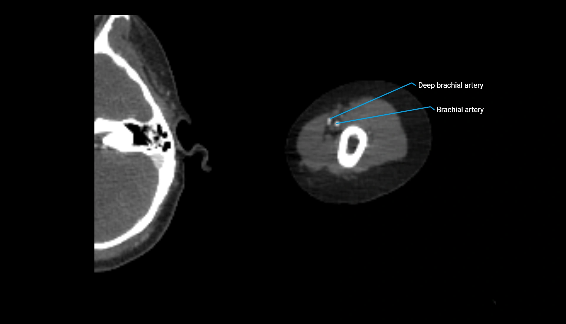 CTA upper limb axial cross sectional anatomy labelled image 260 (2).webp